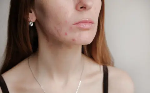 Hautunreinheiten im Gesicht und am Hals. Die Frage: wann normalisiert sich die Haut nach Absetzen der Pille?