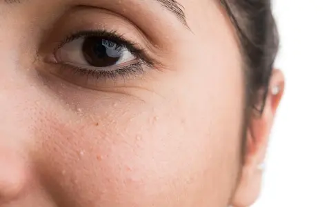Nahaufnahme eines Gesichts mit sichtbaren Milien unter dem Auge.