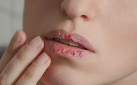 Trockene, rissige Lippen, die fast platzen auf, werden von einer Hand berührt.