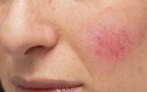 Rötung und Entzündung im Gesicht, Anzeichen einer Kontaktallergie.