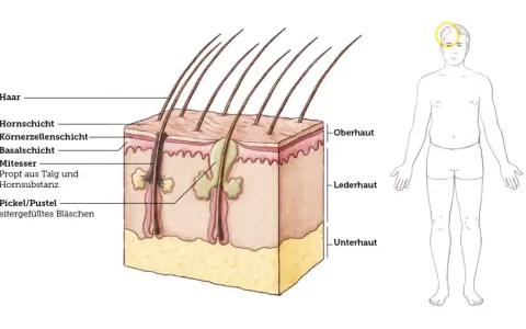 Schnitt durch die Haut zeigt Haarfollikel, Talgdrüsen und einen Mitesser, der aus Talg und Hornsubstanz besteht. Daneben ein schematischer Mensch.