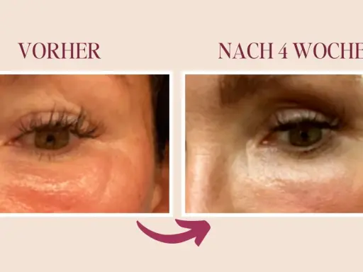 Vorher/Nachher-Vergleich: Reduzierung von Lymphstau im Augenbereich durch sanfte Massage.