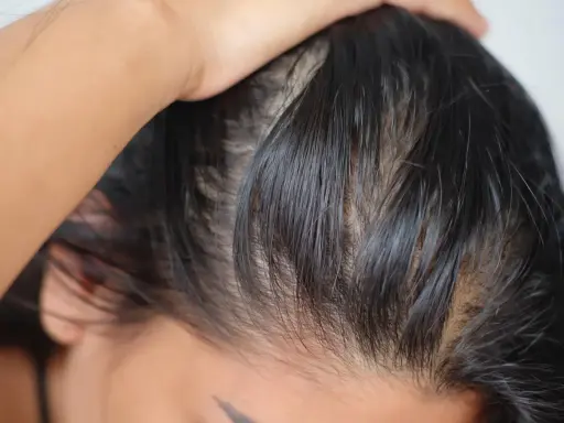 Nahaufnahme von fettigen Haaren, die nach Tipps gegen fettige Haare suchen. Die Kopfhaut ist sichtbar, die Haare wirken strähnig.