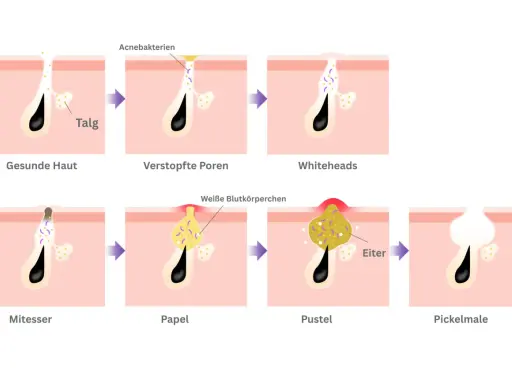 Illustration zeigt, wie Mitesser aussehen: von gesunder Haut über verstopfte Poren und Whiteheads bis zu Pickelmalen.
