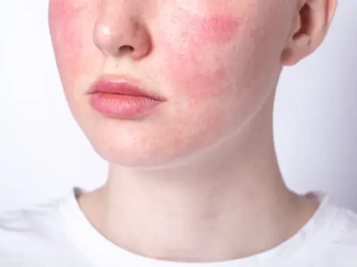 Rötungen im Gesicht, die auf Hautprobleme durch Stress hindeuten. Die Wangen sind gerötet, die Lippen und die Nase sind sichtbar.