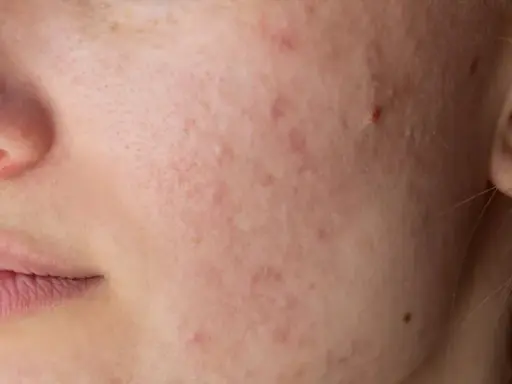 Nahaufnahme eines Gesichts mit Rötungen und Pickelchen um den Mund. Periorale Dermatitis: Nulltherapie hilft nicht.