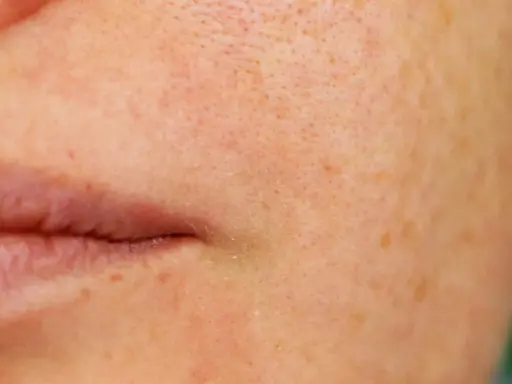 Nahaufnahme der Haut mit sichtbaren Poren und Sommersprossen. Eine sanfte Pflege, was verfeinert die Poren, kann das Hautbild verbessern.