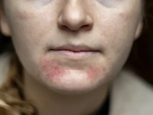 Nahaufnahme des Gesichts einer jungen Frau mit geröteten, entzündeten Stellen und kleinen Pickeln im Kinnbereich.