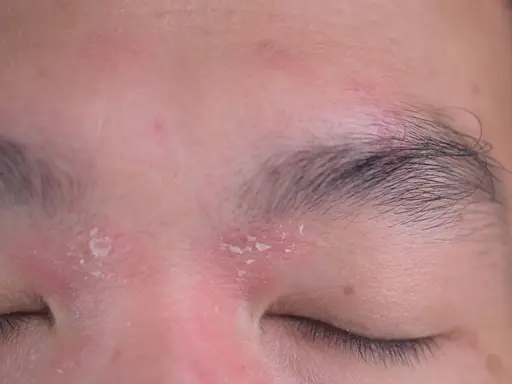 Schuppige Haut um die Augen und Augenbrauen, Anzeichen von Kopfgneis.