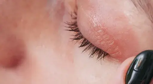 Nahaufnahme einer trockenen Stelle unterm Auge, die mit einem dunklen Nagellackstift berührt wird.