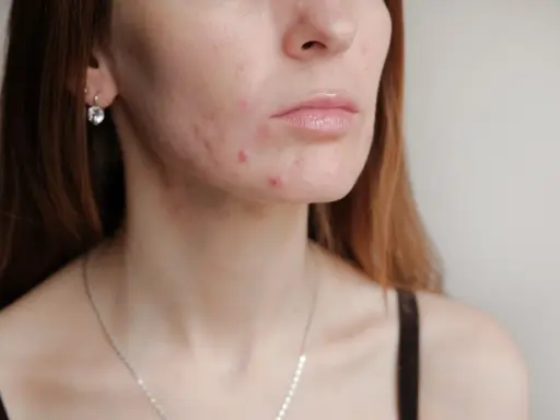 Hautunreinheiten im Gesicht und am Hals. Die Frage: wann normalisiert sich die Haut nach Absetzen der Pille?