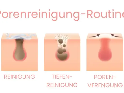 Illustration zeigt die Reinigung von Poren, die schwarze Punkte auf der Haut enthalten. Die Schritte umfassen Vorher, Reinigung, Tiefenreinigung, Porenverengung und Nachher.
