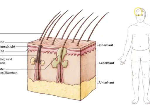 Schnitt durch die Haut zeigt Haarfollikel, Talgdrüsen und einen Mitesser, der aus Talg und Hornsubstanz besteht. Daneben ein schematischer Mensch.