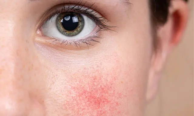 Nahaufnahme eines Gesichts mit geröteter Haut um das Auge, Anzeichen von periorbitaler Dermatitis.