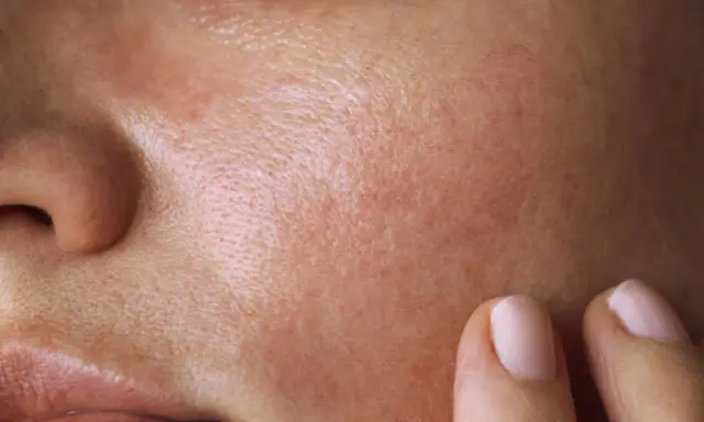 Nahaufnahme der Haut mit sichtbaren Poren und Rötungen. Eine Hand berührt sanft die Wange, als ob sie die Talgproduktion reduzieren möchte.