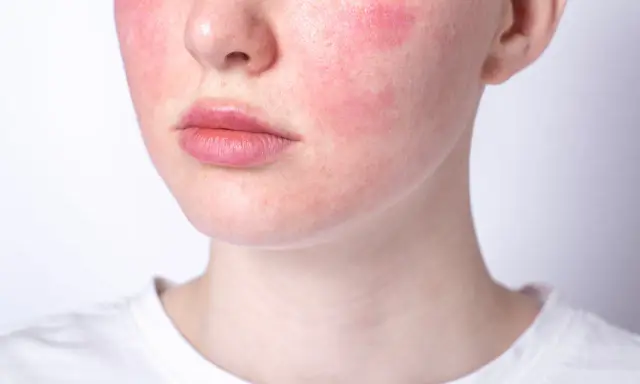 Rötungen im Gesicht, die auf Hautprobleme durch Stress hindeuten. Die Wangen sind gerötet, die Lippen und die Nase sind sichtbar.