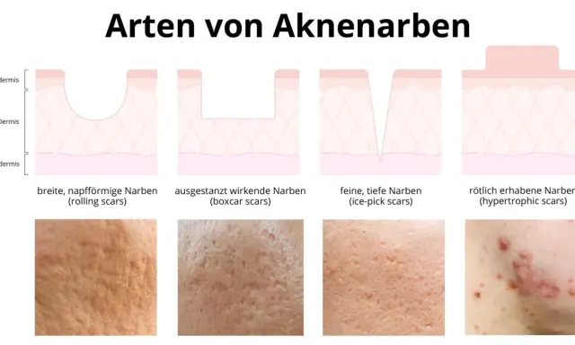 Illustrationen zeigen verschiedene Arten von Aknenarben: rollende, ausgestanzte, eisgepickte und erhabene Narben. Diese sind oft das Ergebnis von Pickelmalen.