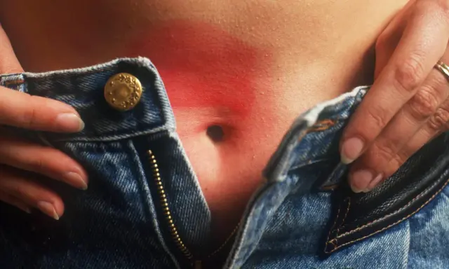 Gerötete Haut am Bauch, möglicherweise durch eine Nickelallergie. Hausmittel können Linderung verschaffen.