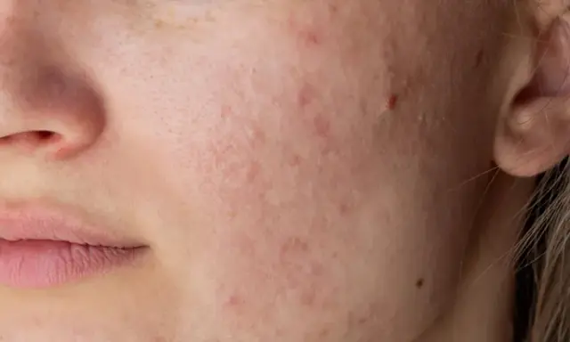 Nahaufnahme eines Gesichts mit Rötungen und Pickelchen um den Mund. Periorale Dermatitis: Nulltherapie hilft nicht.