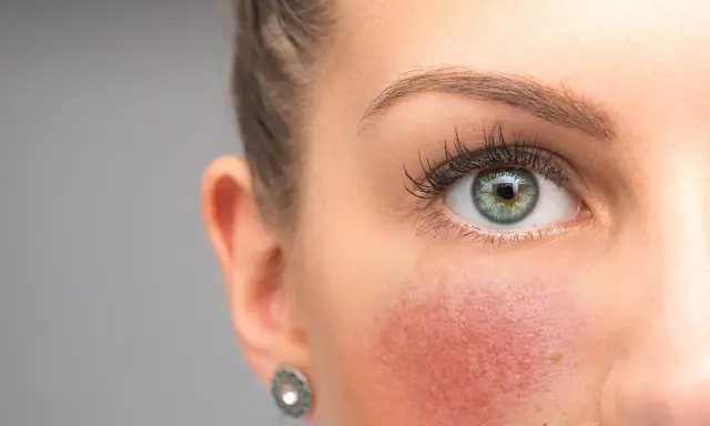 Nahaufnahme eines Gesichts mit geröteten Wangen. Tipps zur **Rosacea vorbeugen** helfen, die Haut zu beruhigen.