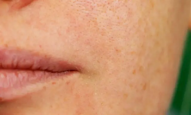 Nahaufnahme der Haut mit sichtbaren Poren und Sommersprossen. Eine sanfte Pflege, was verfeinert die Poren, kann das Hautbild verbessern.