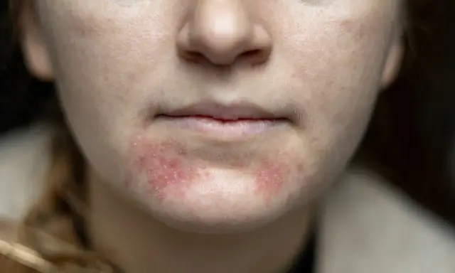 Nahaufnahme des Gesichts einer jungen Frau mit geröteten, entzündeten Stellen und kleinen Pickeln im Kinnbereich.
