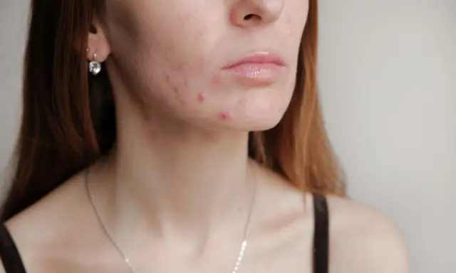 Hautunreinheiten im Gesicht und am Hals. Die Frage: wann normalisiert sich die Haut nach Absetzen der Pille?