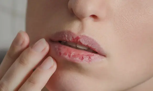 Trockene, rissige Lippen, die fast platzen auf, werden von einer Hand berührt.