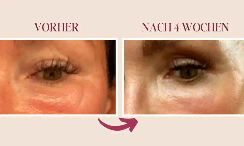 Vorher/Nachher-Vergleich: Reduzierung von Lymphstau im Augenbereich durch sanfte Massage.