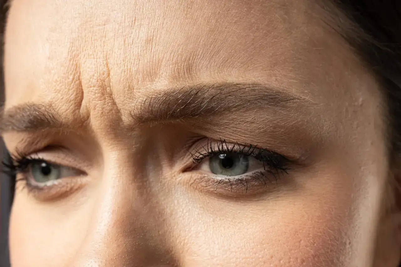 Nahaufnahme einer Stirn mit sichtbaren Zornesfalten, die durch Make-up kaschiert werden könnten.