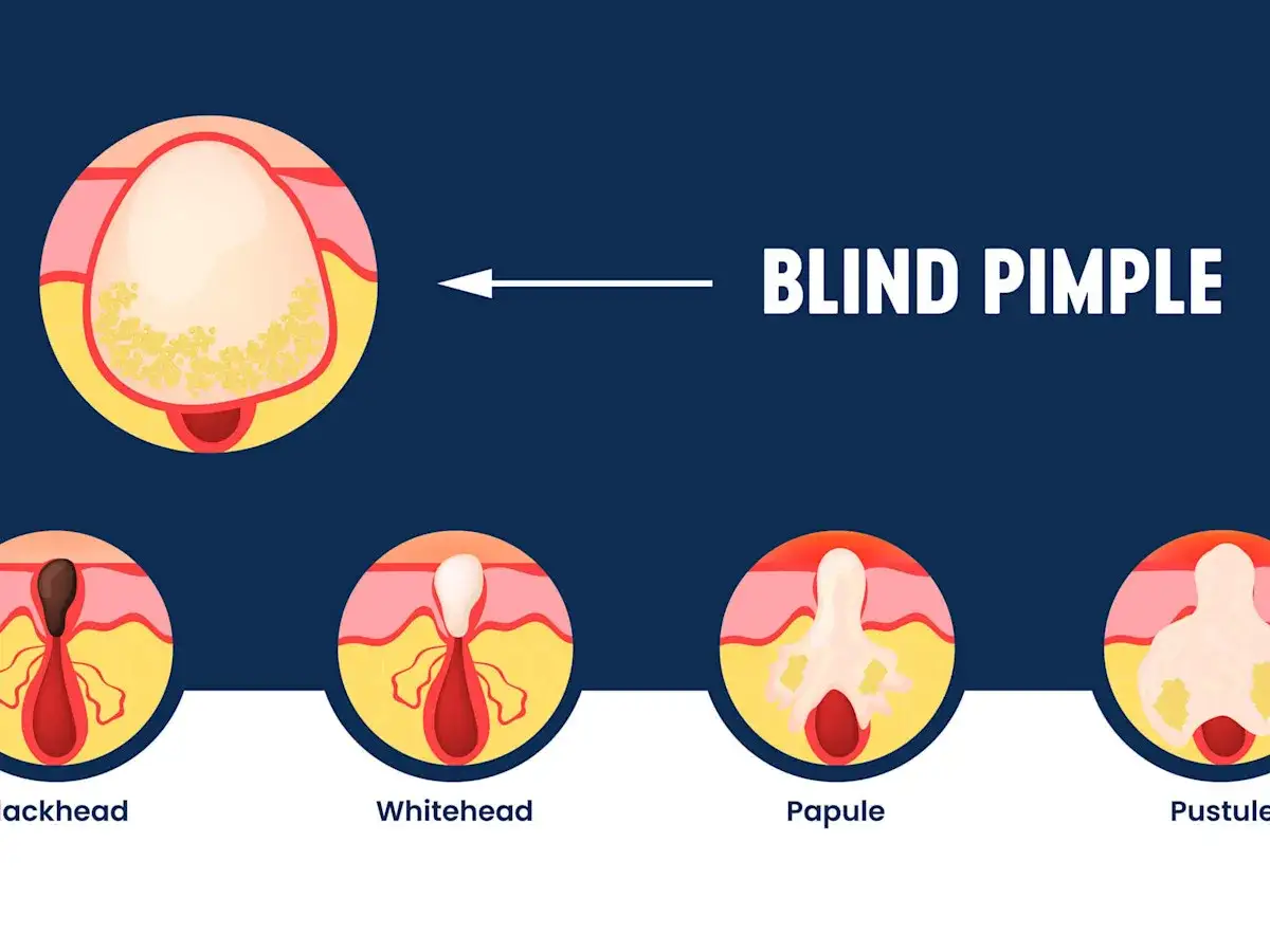 Illustration zeigt, wie entstehen unterirdische Pickel: Blackhead, Whitehead, Papule und Pustule. Ein Blind Pimple ist tief in der Haut.