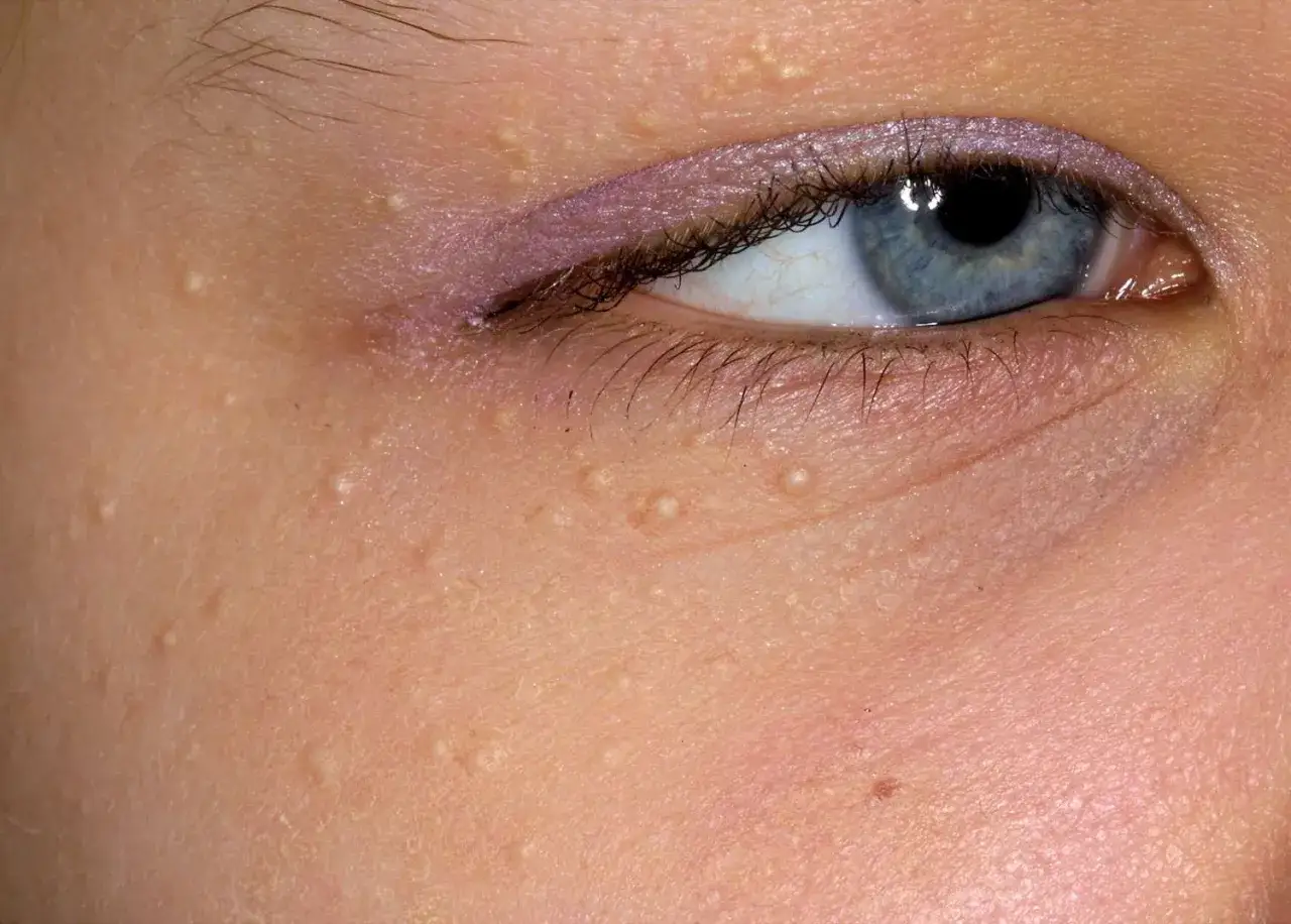 Nahaufnahme eines Gesichts mit vielen kleinen, wei&szlig;en Milien um das Auge. Die Haut ist leicht ger&ouml;tet.