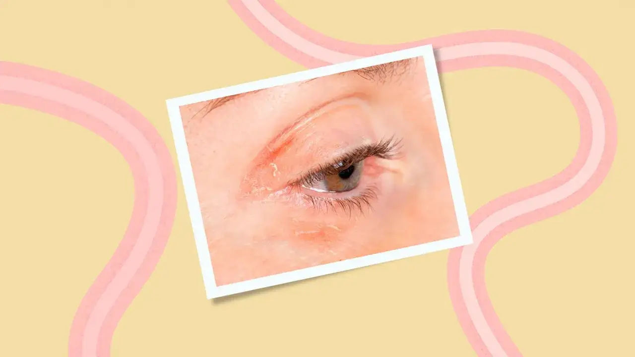 Nahaufnahme eines Auges mit Anzeichen von periorbitaler Dermatitis, die sich durch trockene, schuppige Haut um das Auge auszeichnet.