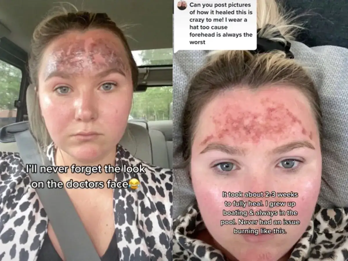 Frau mit stark geröteter, geschwollener Stirn und Wangen. Sie vermutet, dass abgelaufene Sonnencreme die Ursache für die Verbrennung ist.