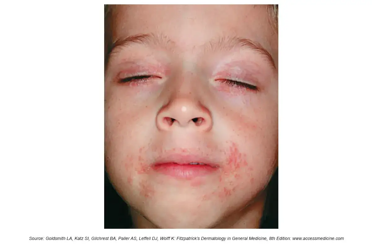 Kind mit geröteter Haut um Mund und Augen. Periorale Dermatitis: Nulltherapie hilft nicht.