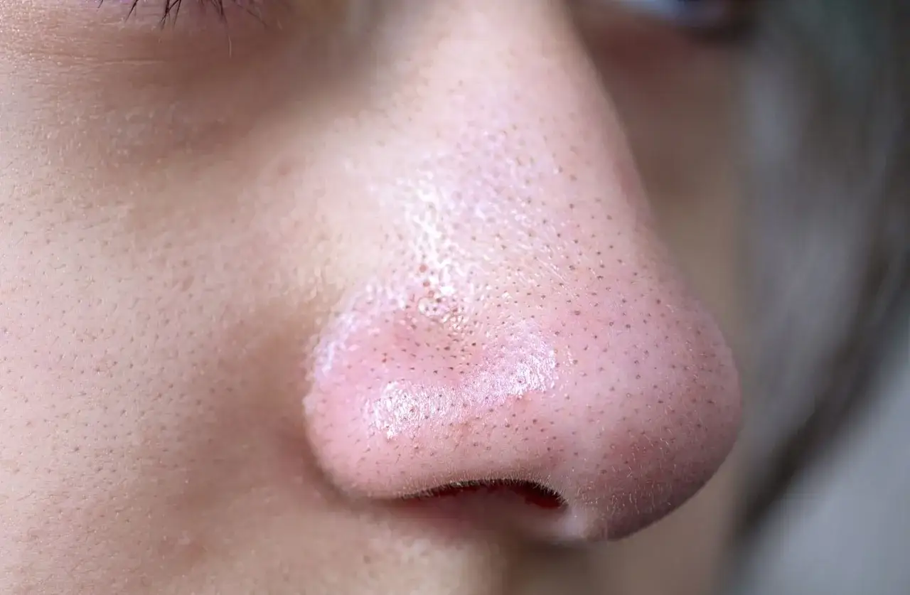 Nahaufnahme der Nase mit sichtbaren Poren. Ein hartn&auml;ckiger Mitesser kommt immer wieder an gleicher Stelle zum Vorschein.