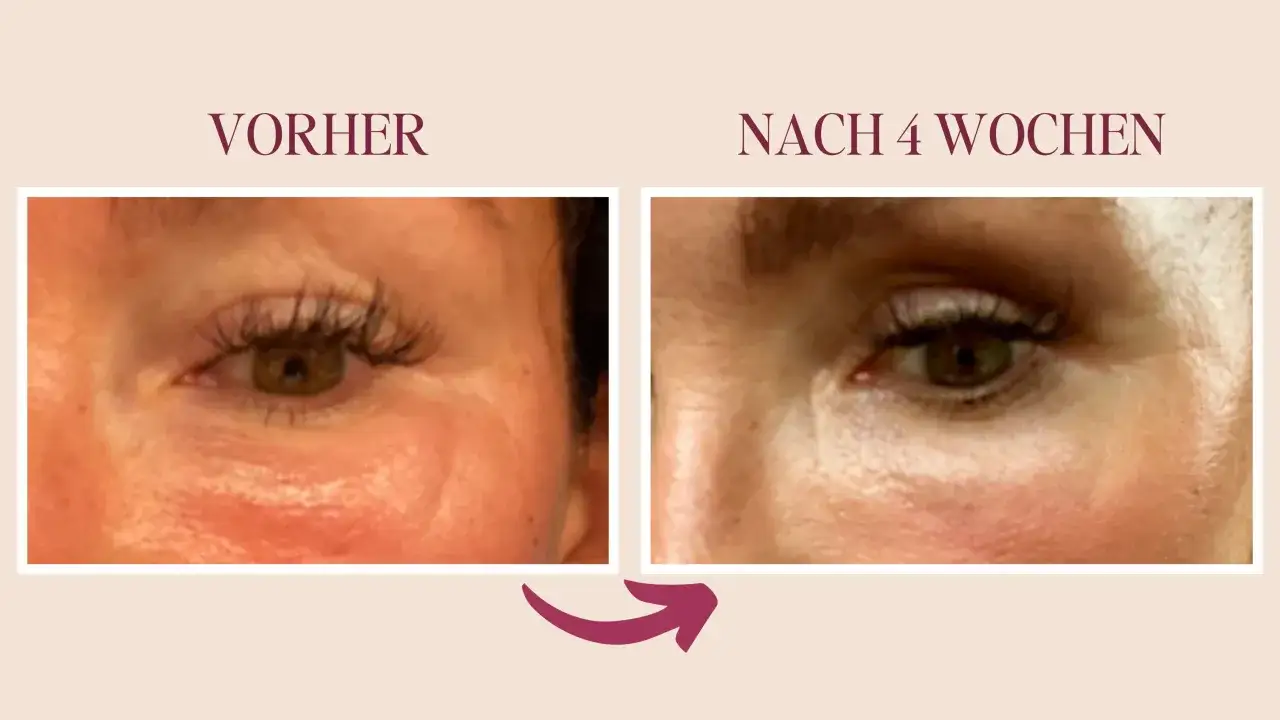 Vorher: aufgedunsenes Gesicht mit Falten unter dem Auge. Nach 4 Wochen: glattere Haut unter dem Auge.