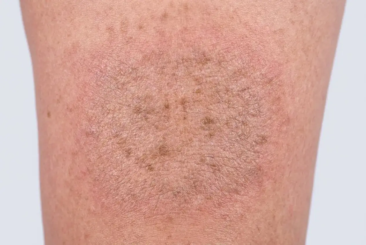 Nahaufnahme von trockenen Beinen mit rauer Haut und Pigmentflecken.