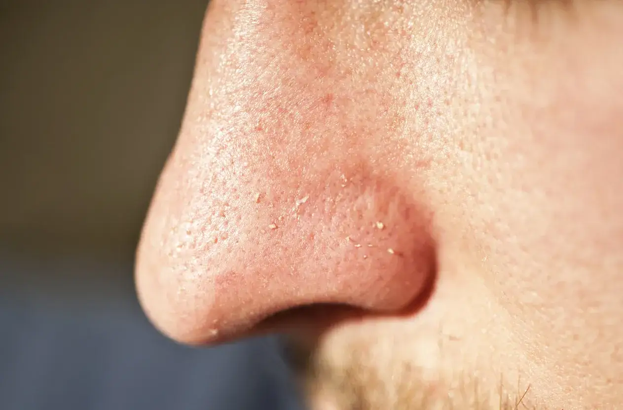 Nahaufnahme der Nase mit sichtbaren Poren und einigen kleinen, hellen schwarzen Punkten auf der Haut.