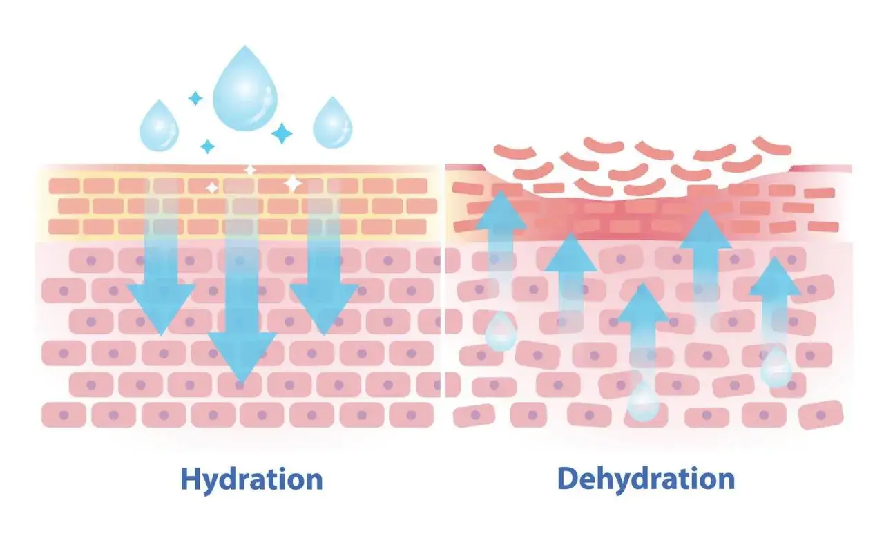 Vergleich von Haut-Hydration und Dehydration. Glycerin wirkt feuchtigkeitsspendend, indem es Wasser in die Haut zieht.