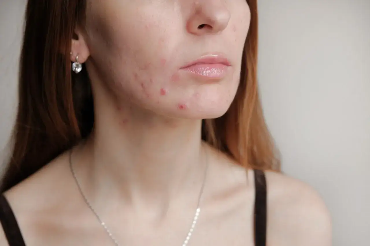 Hautunreinheiten im Gesicht und am Hals. Frage: Wann normalisiert sich die Haut nach Absetzen der Pille?
