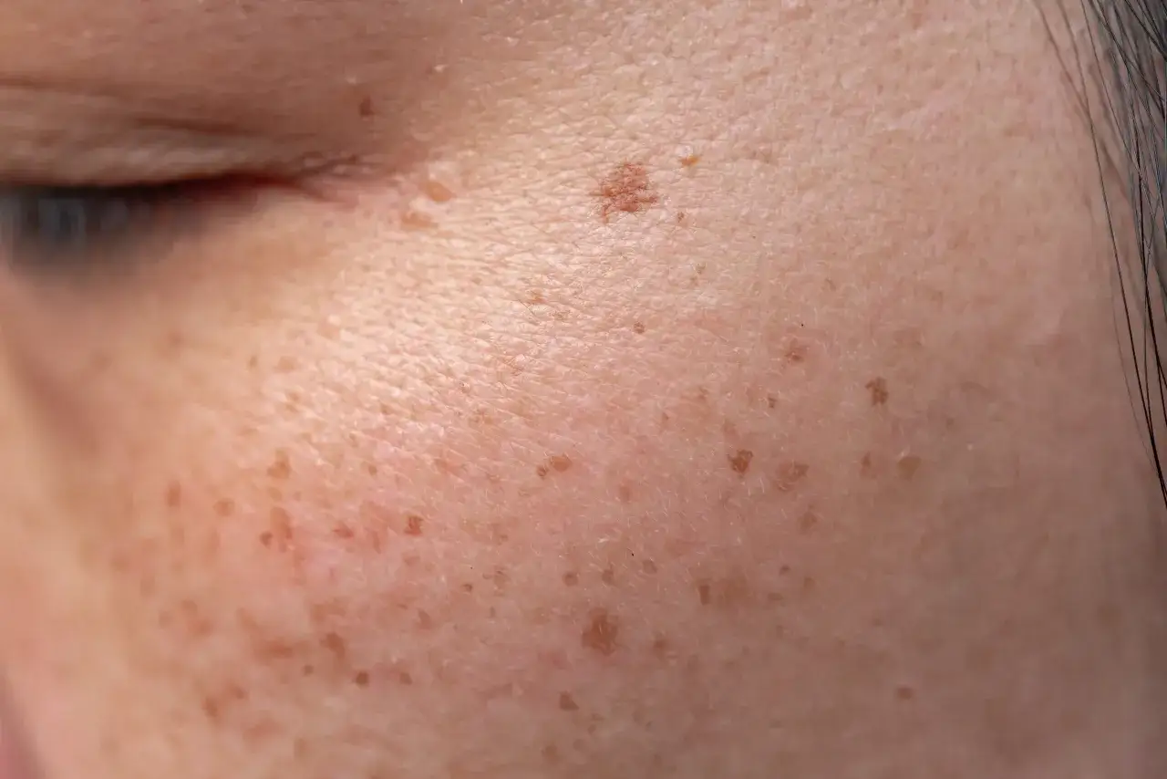 Nahaufnahme der Haut mit vielen kleinen Pickeln und Sommersprossen im Gesicht.