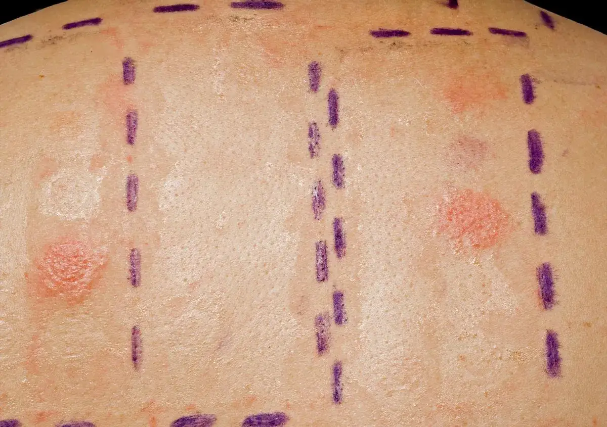 Hautirritationen nach einem Test auf panthenol allergie. Rote, erhabene Stellen auf der Haut, markiert mit lila Strichen.